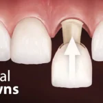 Dental Crowns