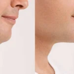 Neck Lift in Dubai